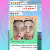 ژل کوچک کننده بینی مرهم شفای یارا