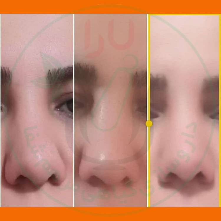 ژل کوچک کننده بینی مرهم شفای یارا